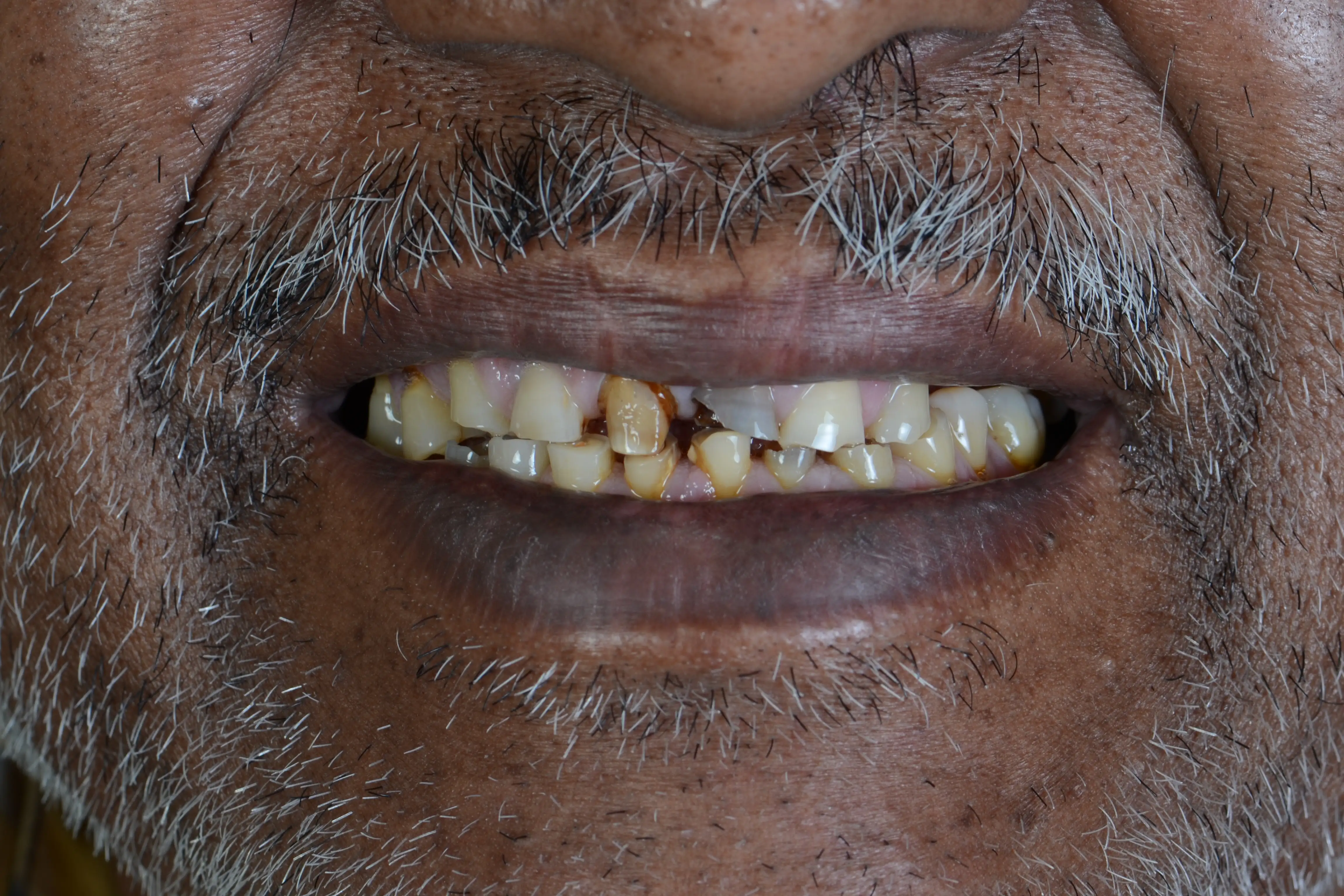 Before treatment