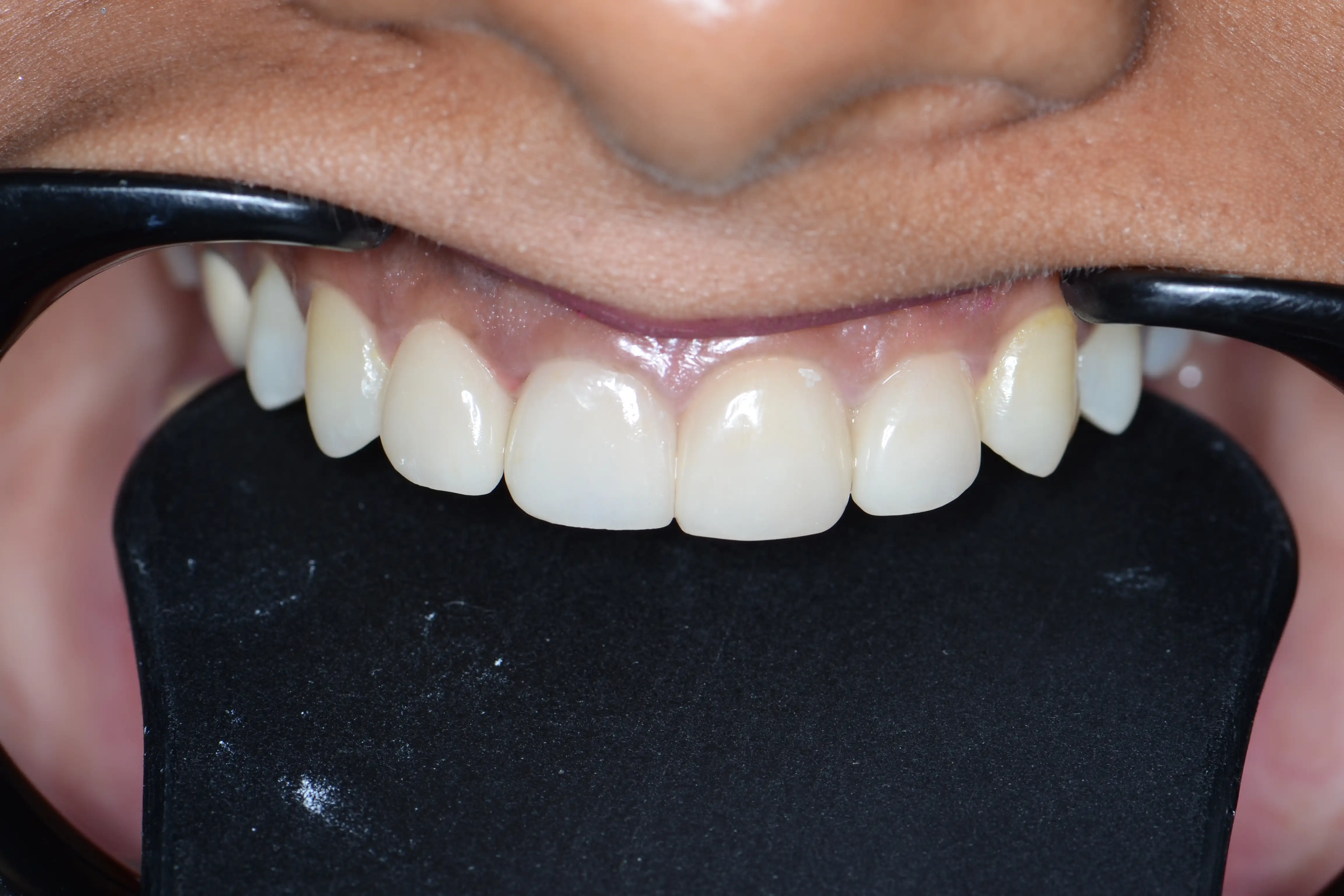 After treatment