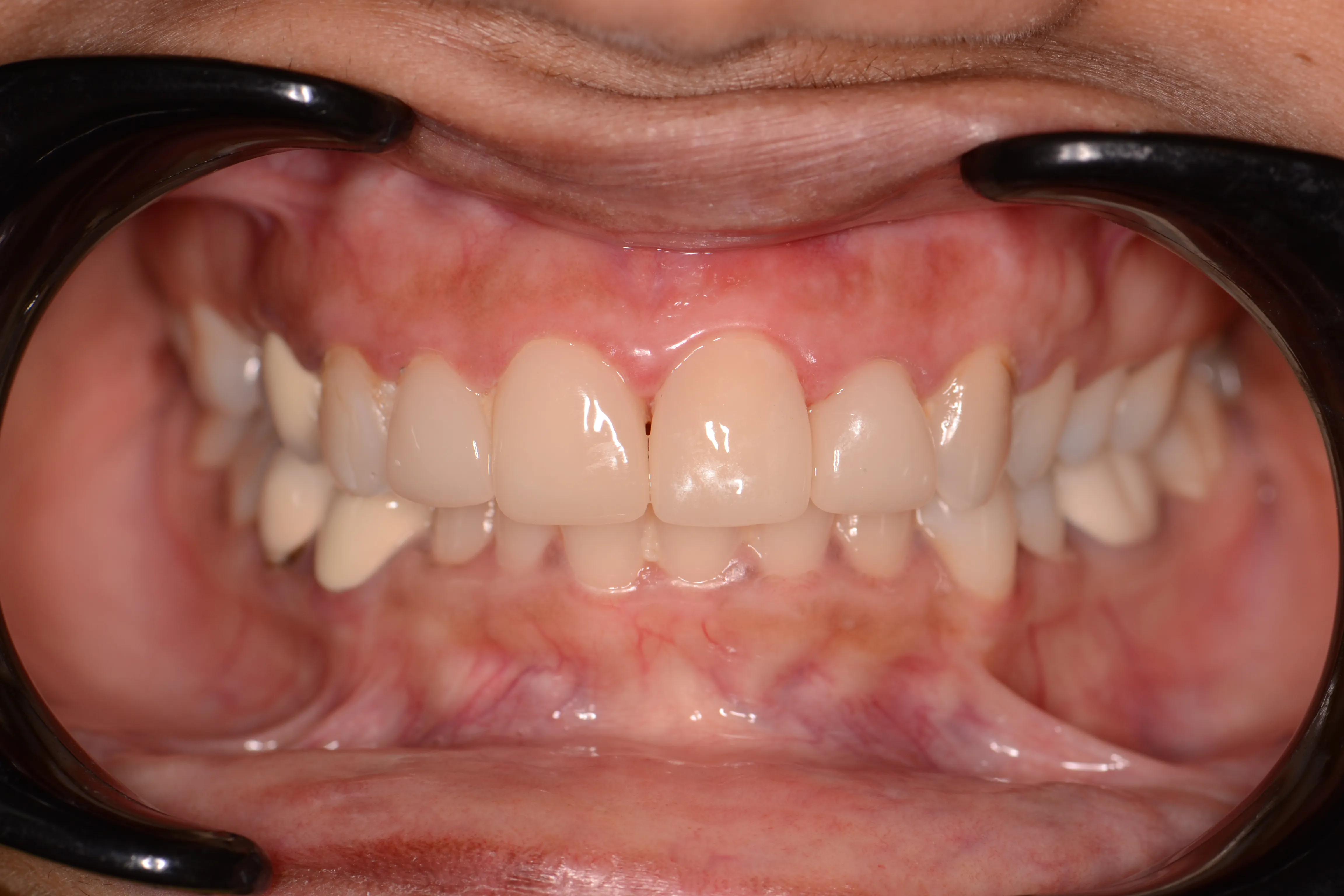 After treatment