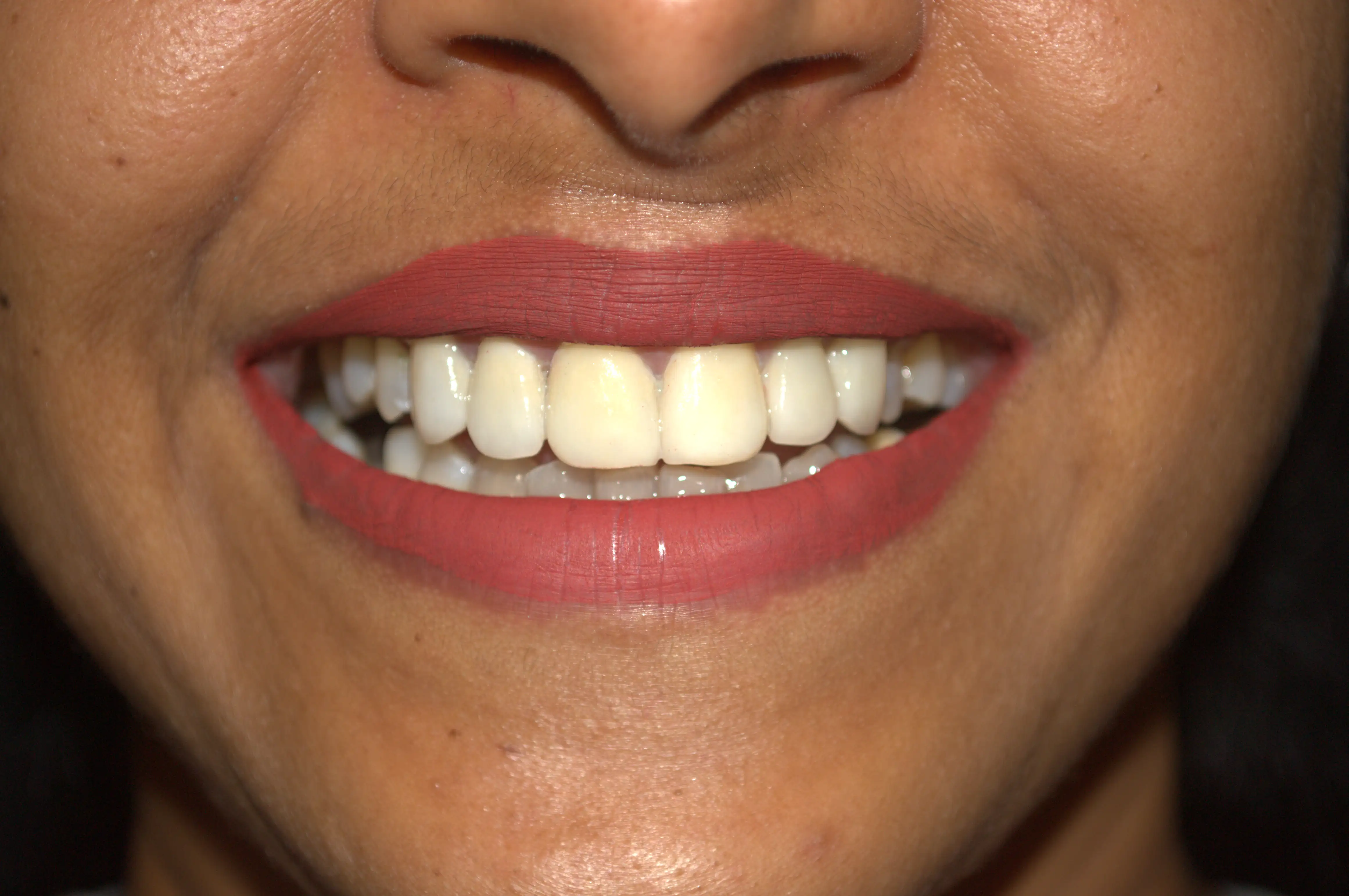 After treatment