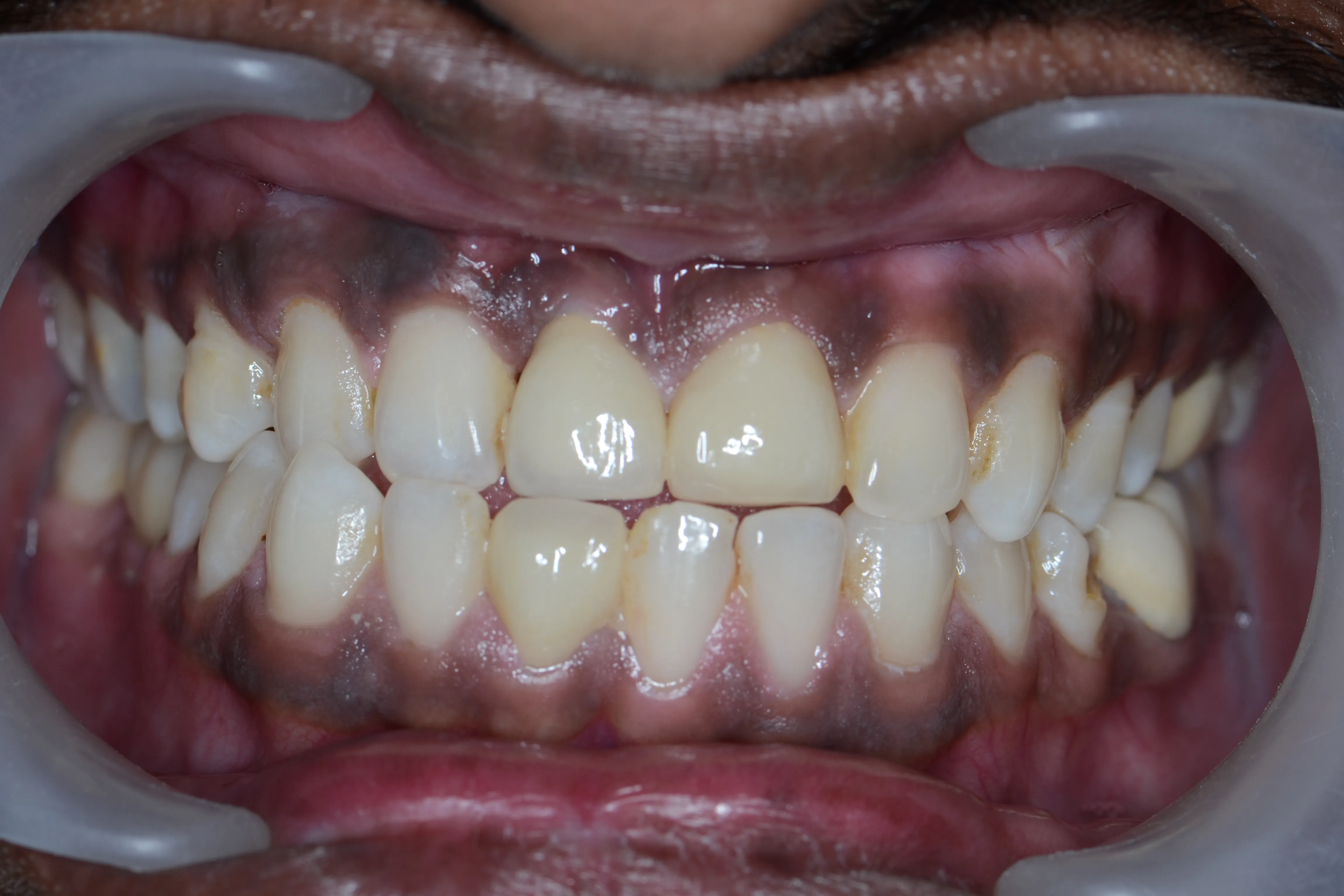 After treatment