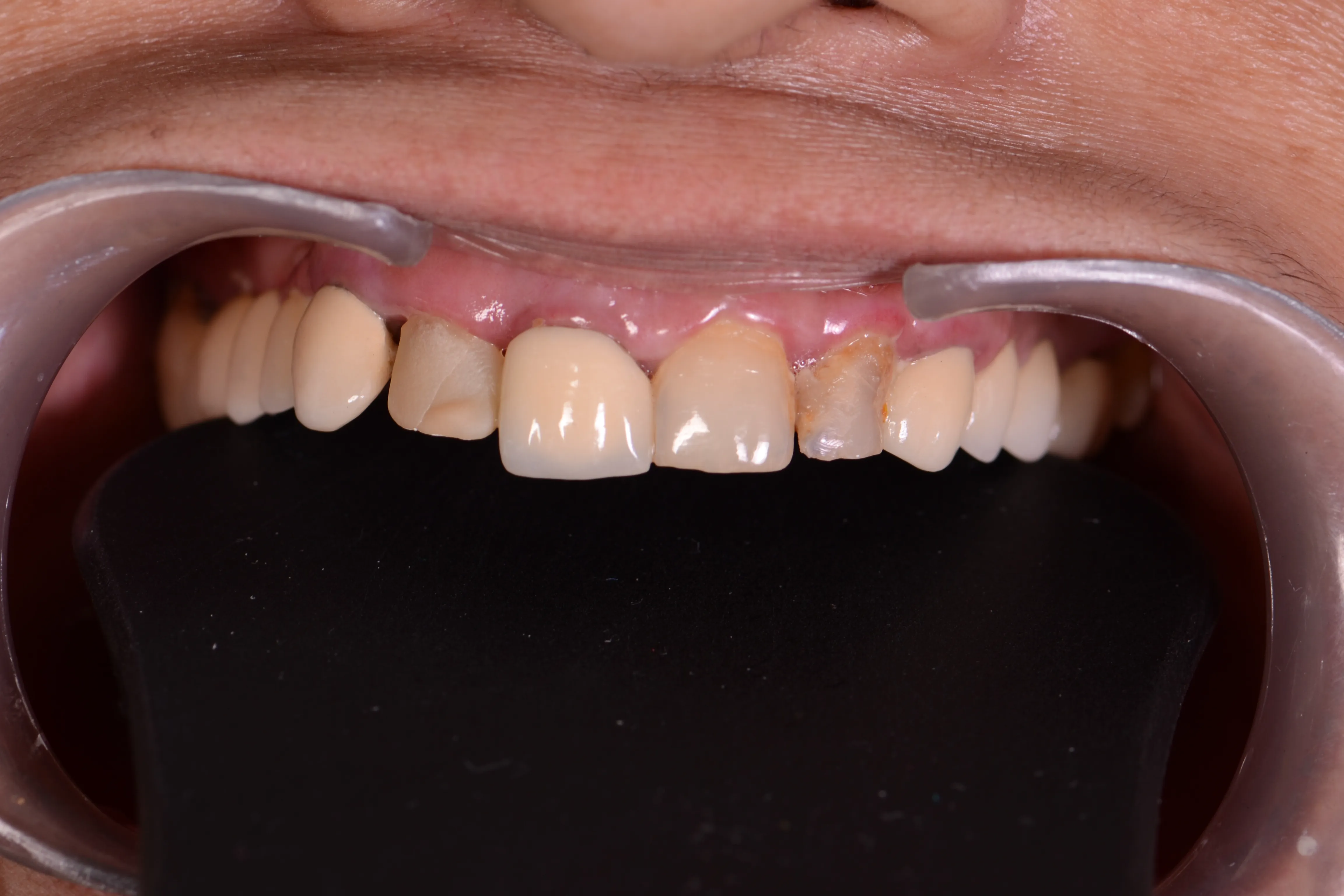 Before treatment