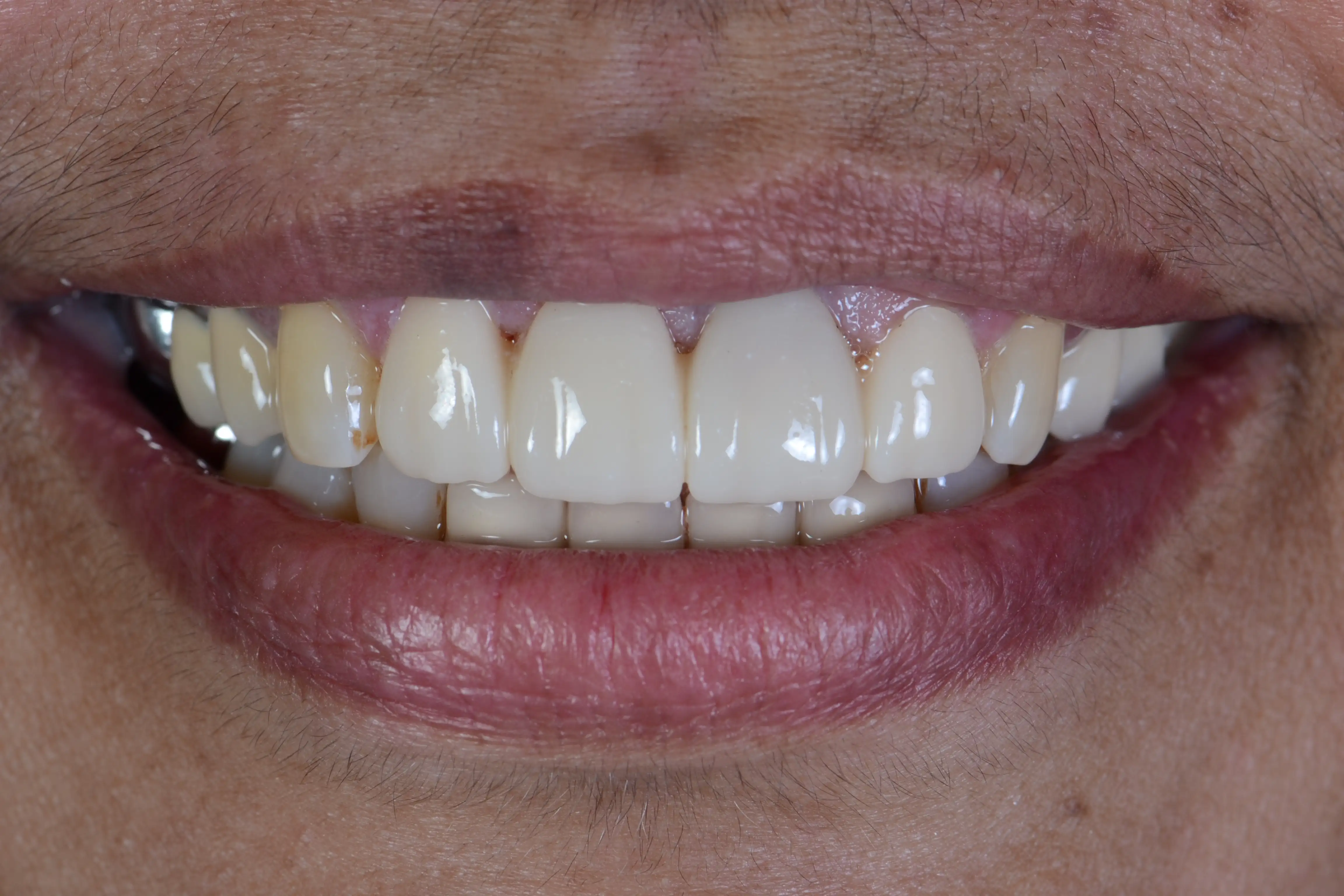 After treatment