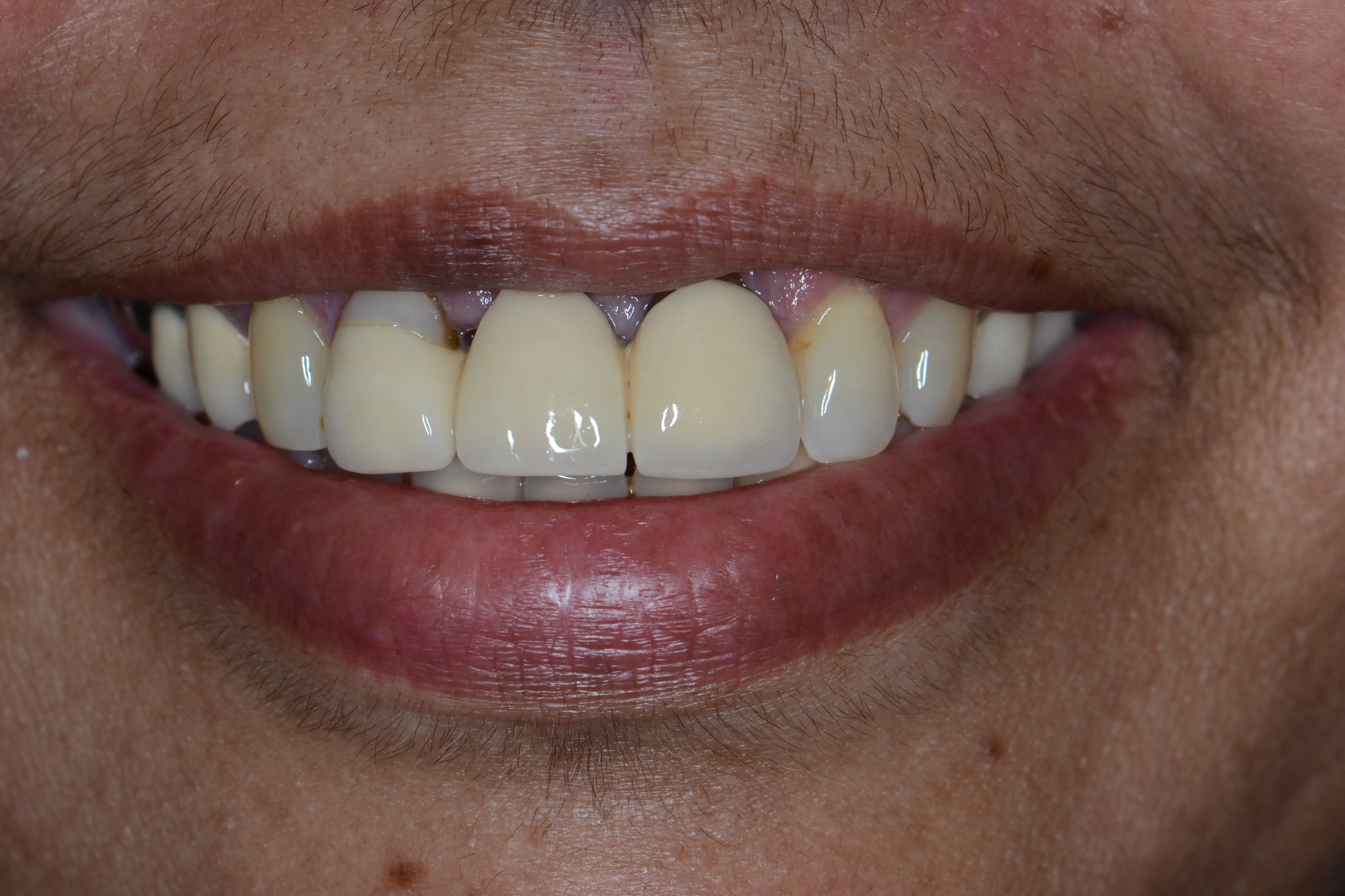 Before treatment