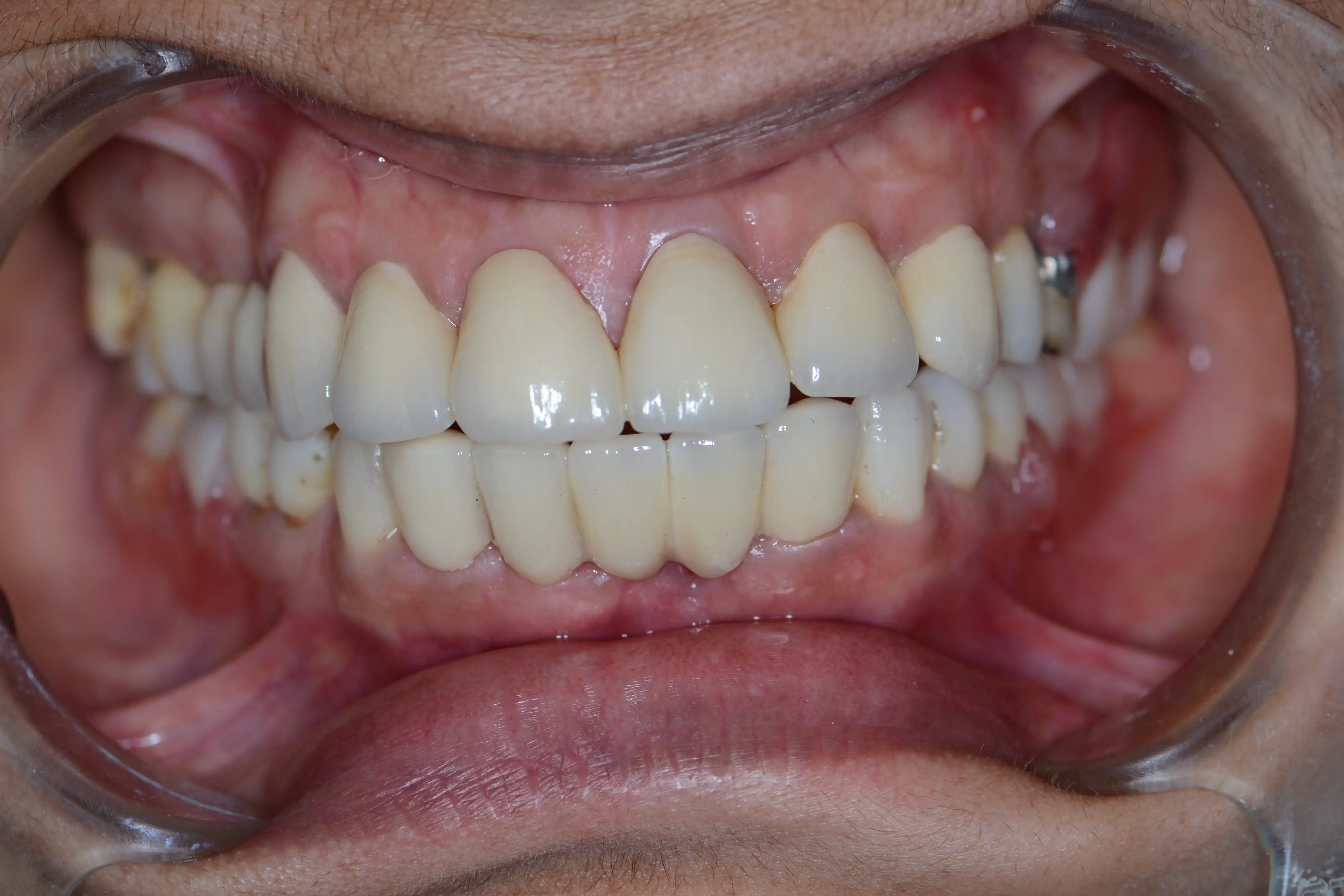After treatment
