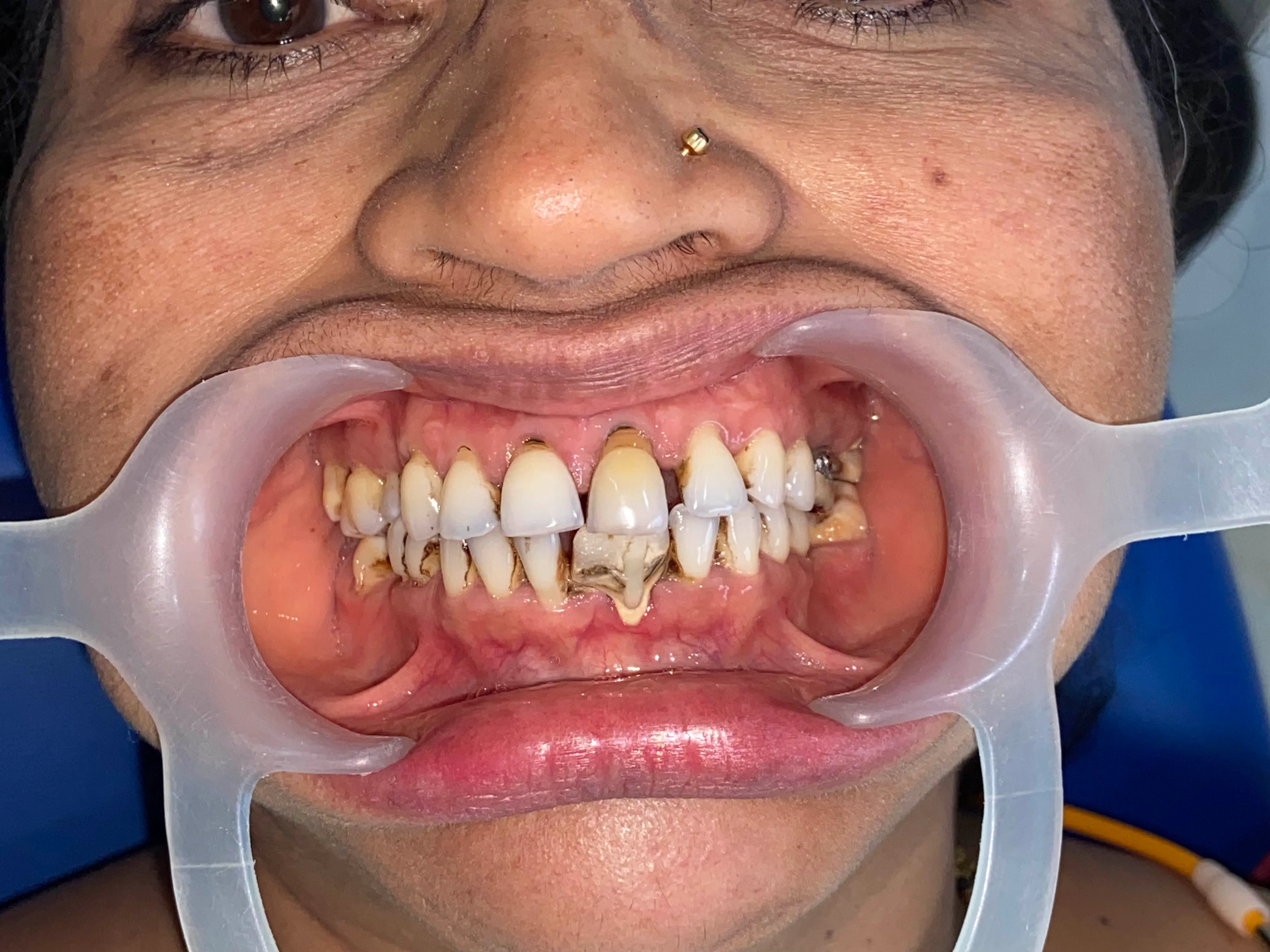 Before treatment