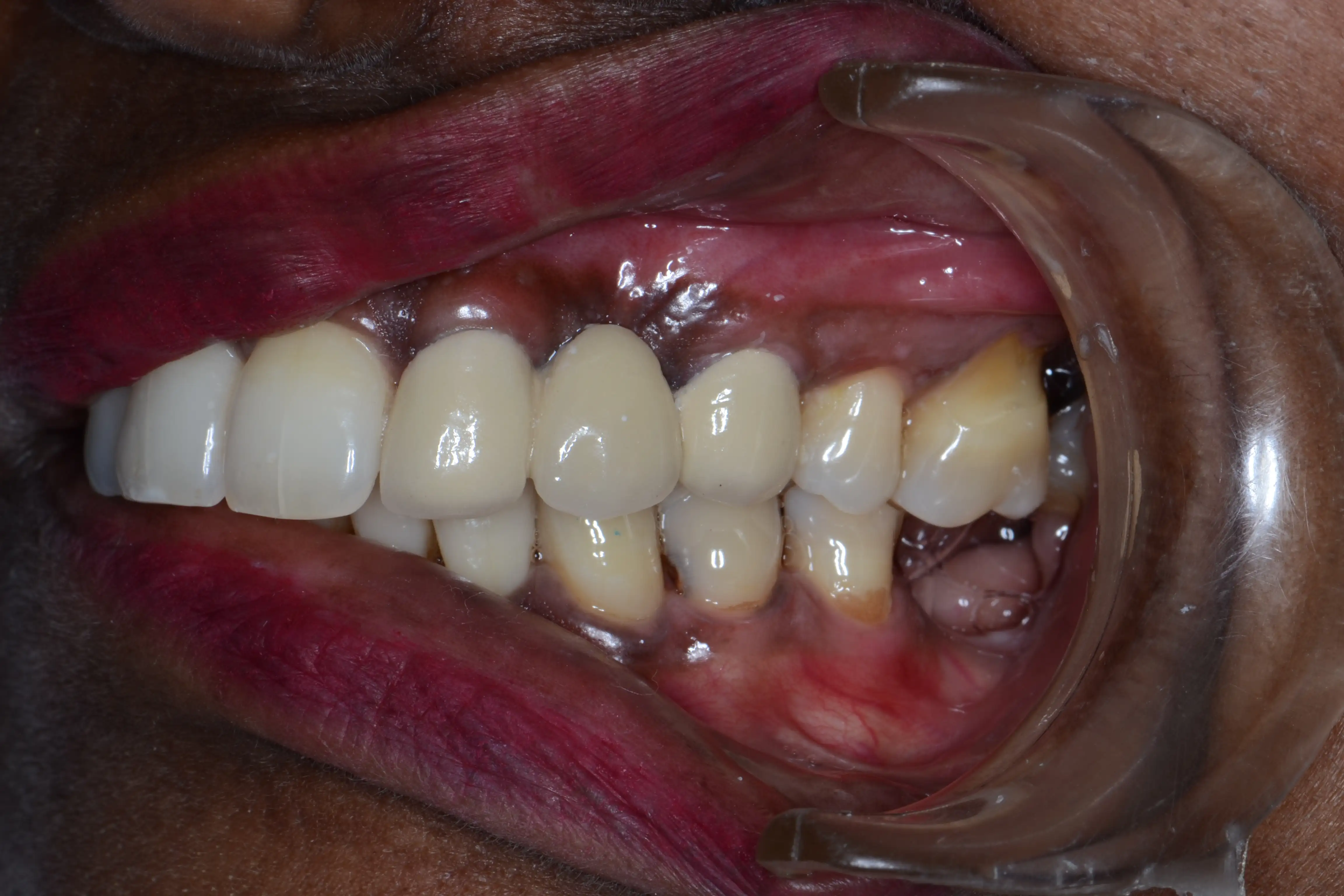 After treatment