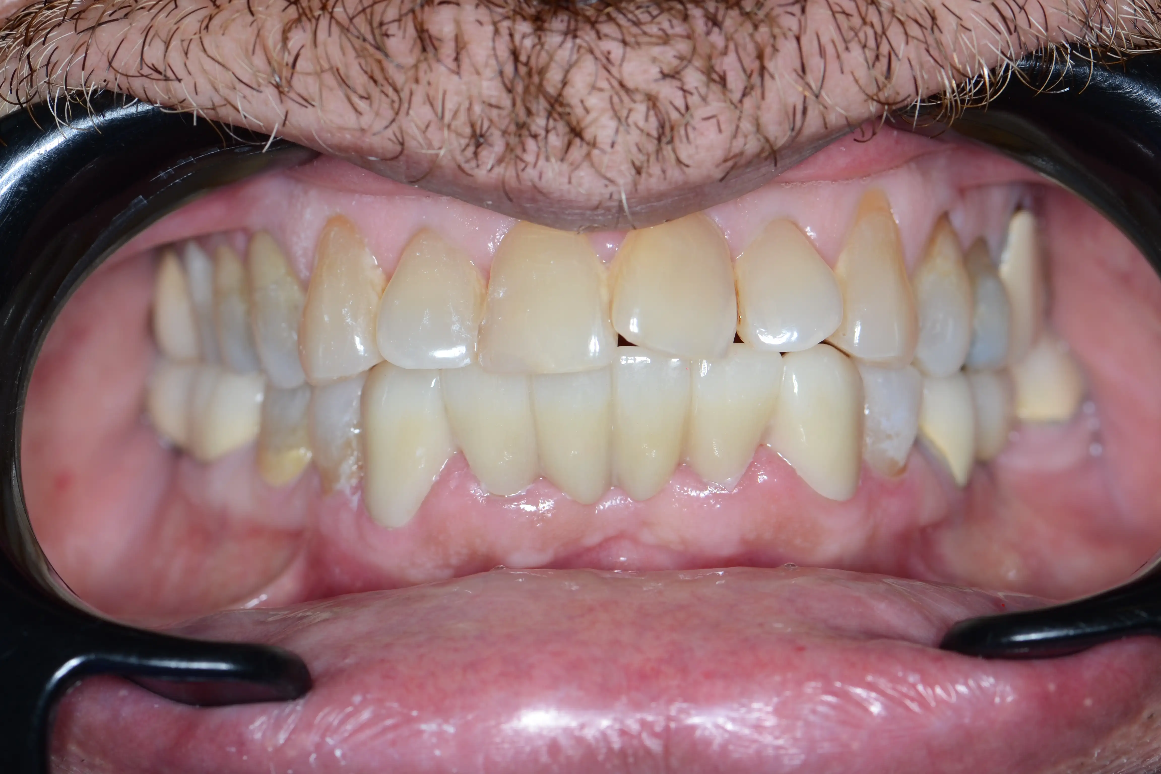 After treatment
