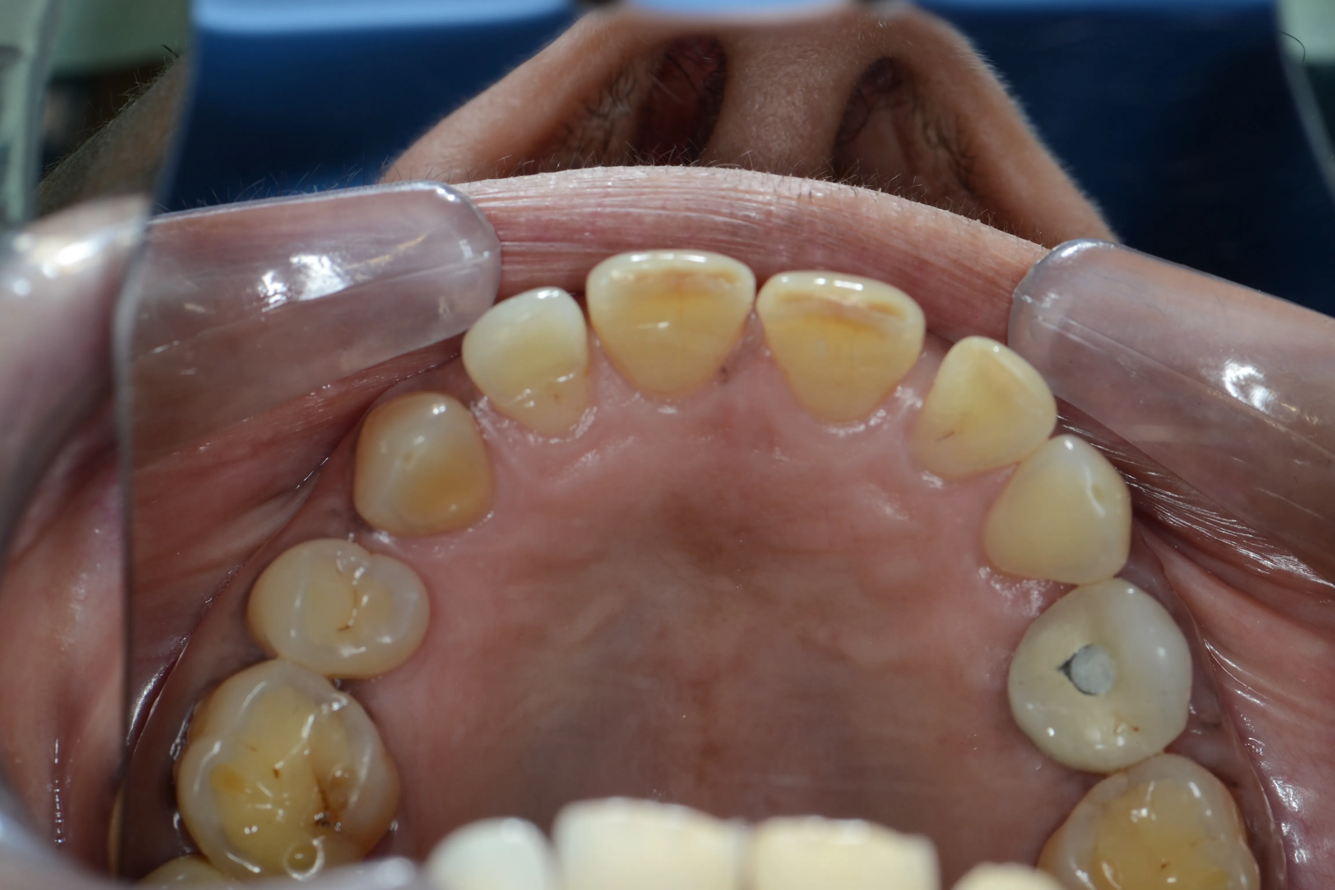 After treatment