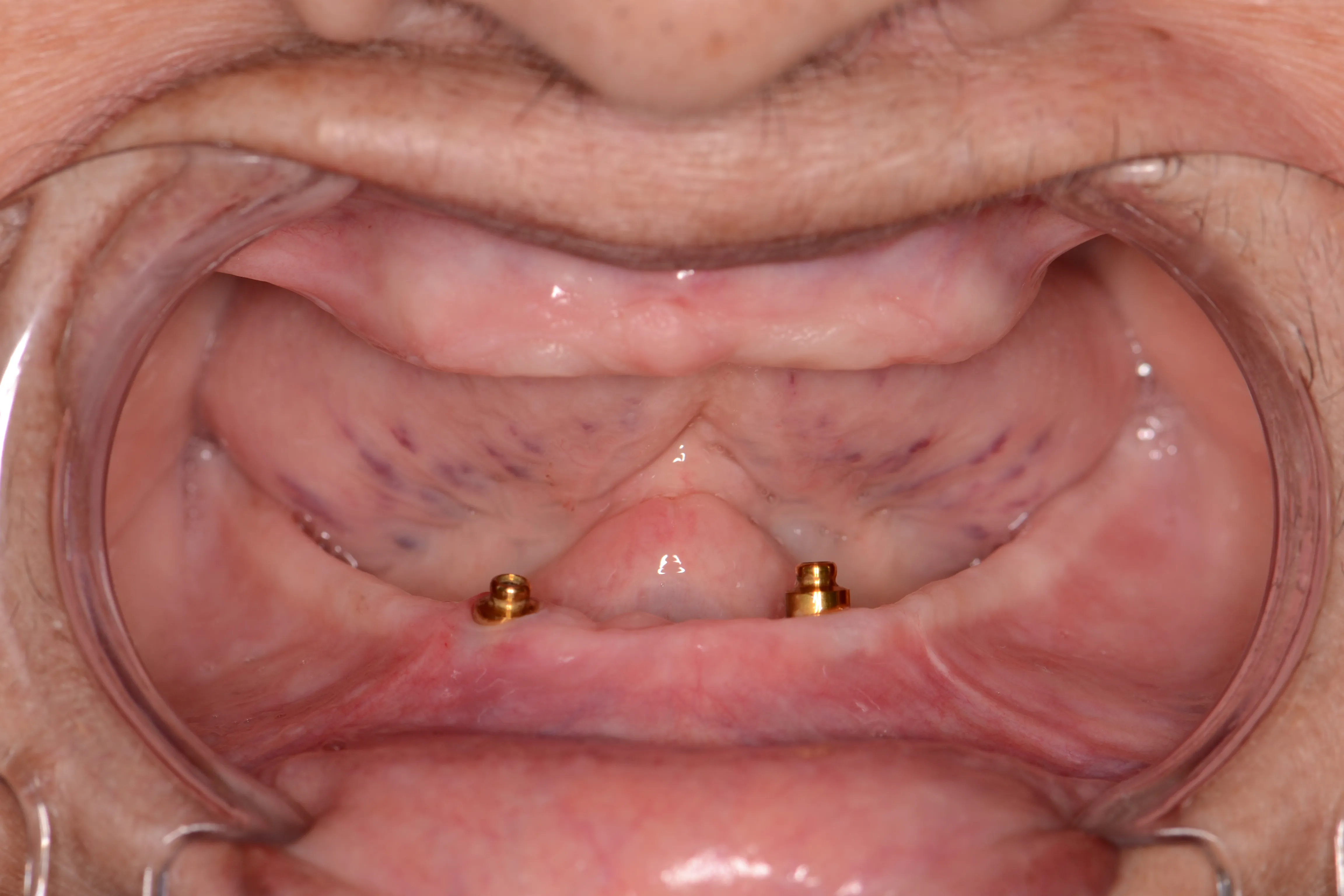 After treatment